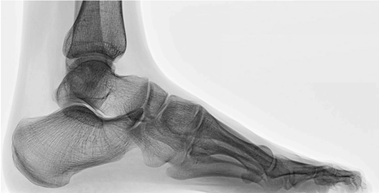 Weight-bearing X-ray of a foot and ankle